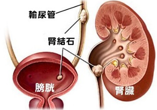 尿路结石2.jpg