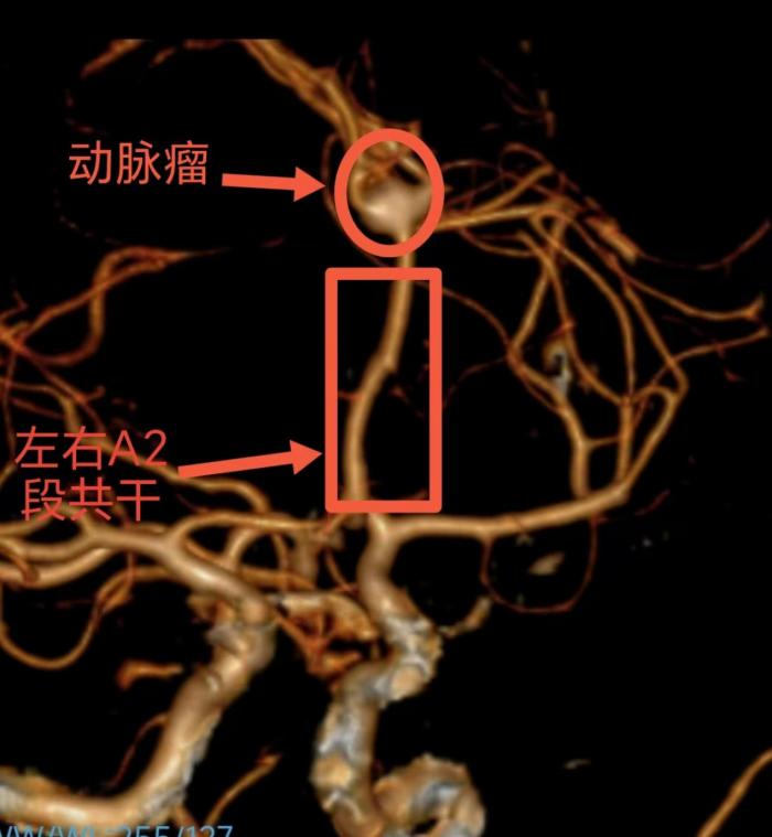 挑战大脑血管“畸路”：三甲医院精准夹闭颅内“炸弹”