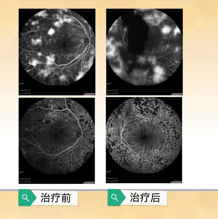 守护“糖友”视界：别让高血糖悄悄偷走视力1 (3).jpg