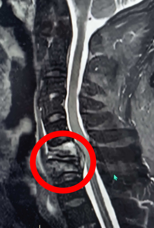 绝境逢生!67岁大爷“颈椎结核+严重心衰”,1.5小时手术改写命运1 (3).png 绝境逢生!67岁大爷“颈椎结核+严重心衰”,1.5小时手术改写命运1 (3).png