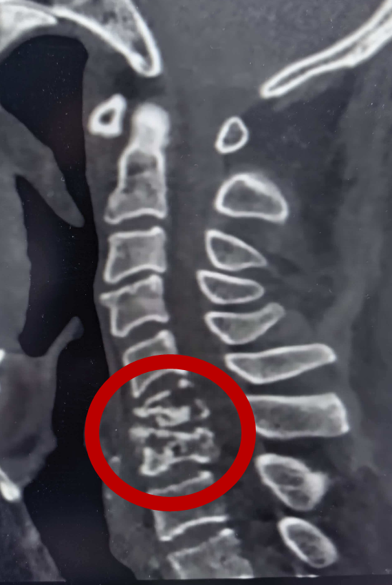 绝境逢生!67岁大爷“颈椎结核+严重心衰”,1.5小时手术改写命运1 (2).png 绝境逢生!67岁大爷“颈椎结核+严重心衰”,1.5小时手术改写命运1 (2).png