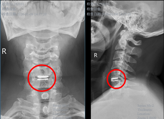 颈椎“焕新”不僵硬！微创人工颈椎间盘置换术助患者重获健康1 (2).png
